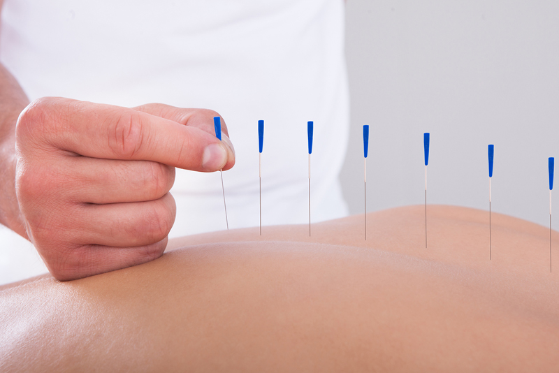 Acupuncture Physiotherapy Whitstable